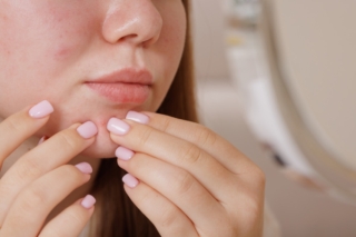 Acne in adolescenza Acne in adolescenza