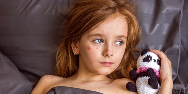 Morbillo: Italia seconda in Europa per contagi, il parere del virologo Pregliasco