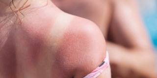 Scottature solari e arrossamenti nei bambini: cosa mettere e i rimedi naturali Scottature solari e arrossamenti nei bambini: cosa mettere e i rimedi naturali