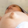 Ernia ombelicale neonato