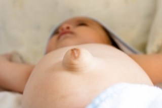 Ernia ombelicale neonato Ernia ombelicale neonato