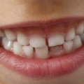 Apparecchio denti bambini
