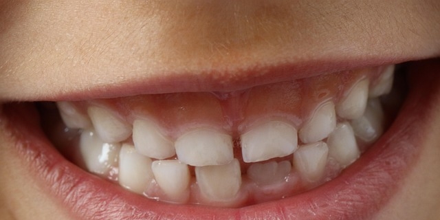 Apparecchio ai denti per bambini: tipologie e costi