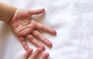 psoriasi mani bambini