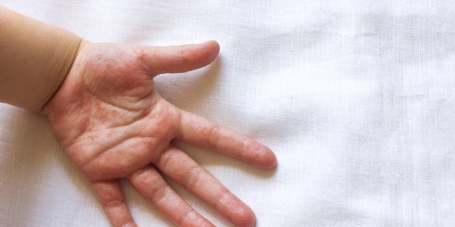 Psoriasi nei bambini, come si manifesta e si cura