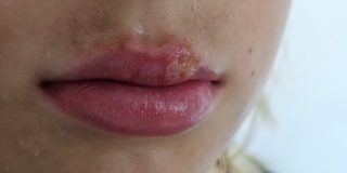 Sorella “grande” con herpes labiale: come proteggere la piccolina?