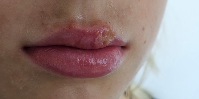 Sorella “grande” con herpes labiale: come proteggere la piccolina?
