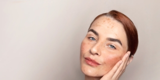 Cloasma gravidico al viso: cause e rimedi