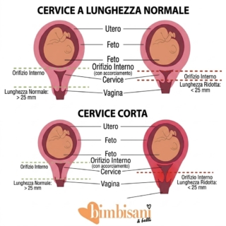Collo utero accorciato Collo utero accorciato
