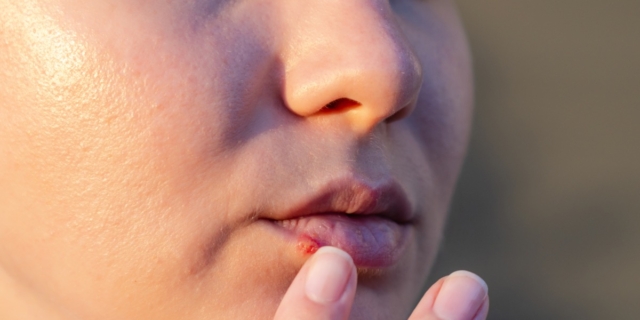 Herpes simplex labiale: è pericoloso per una bimba di sette mesi?