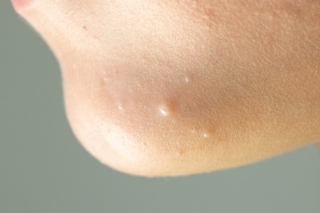 mollusco contagioso
