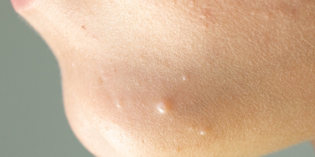 Mollusco contagioso: come si prende, sintomi e cure