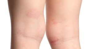 Micosi cutanee nei bambini: come si prendono e si curano