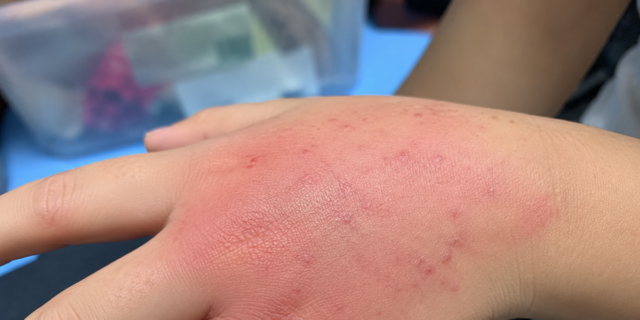 Puntura di pesce scorpione: come intervenire se capita ai bambini
