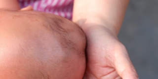 Tumore da parto e cefaloematoma nel neonato: cause e conseguenze